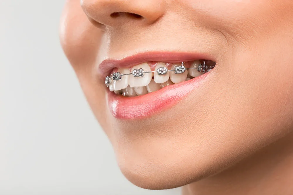 what-is-orthodontics-4